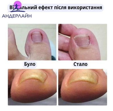 Набор пластырей Elastic Toenail Correction Sticker для коррекции и устранения вросших ногтей (50 шт.)